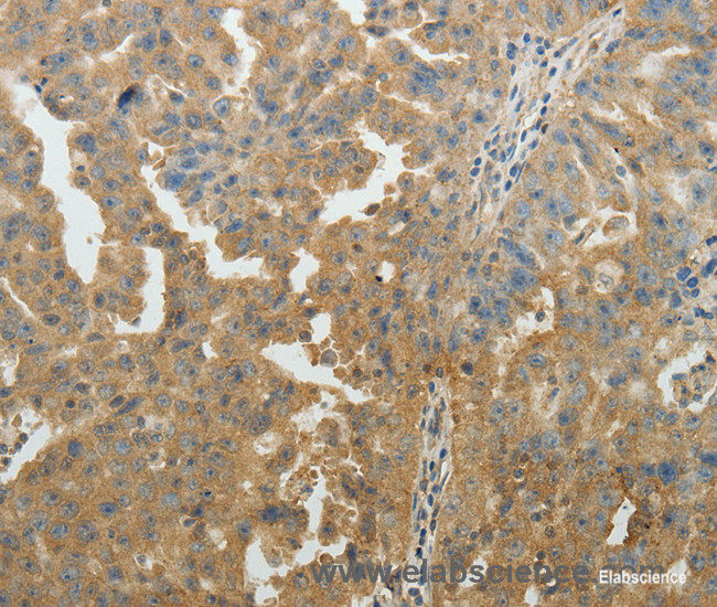 Immunohistochemistry of paraffin-embedded Human ovarian cancer tissue using SYT6 Polyclonal Antibody at dilution 1:40