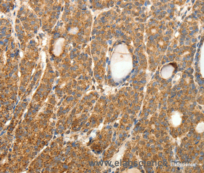 Immunohistochemistry of paraffin-embedded Human thyroid cancer tissue using SYT11 Polyclonal Antibody at dilution 1:30