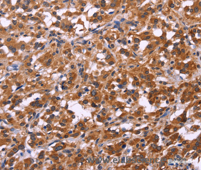 Immunohistochemistry of paraffin-embedded Human thyroid cancer tissue using SPATA7 Polyclonal Antibody at dilution 1:30