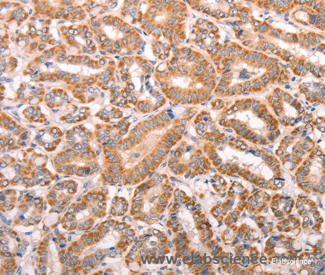 Immunohistochemistry of paraffin-embedded Human thyroid cancer tissue using TRPV4 Polyclonal Antibody at dilution 1:40