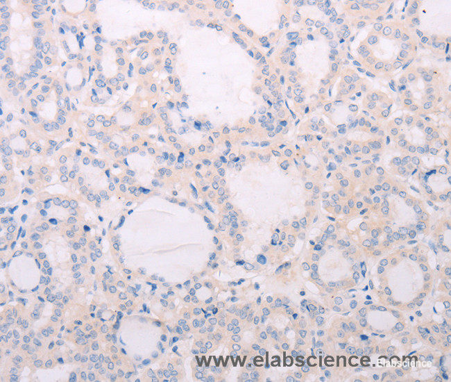 Immunohistochemistry of paraffin-embedded Human thyroid cancer tissue using TSHR Polyclonal Antibody at dilution 1:50