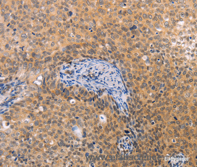 Immunohistochemistry of paraffin-embedded Human cervical cancer tissue using pVHL Polyclonal Antibody at dilution 1:40