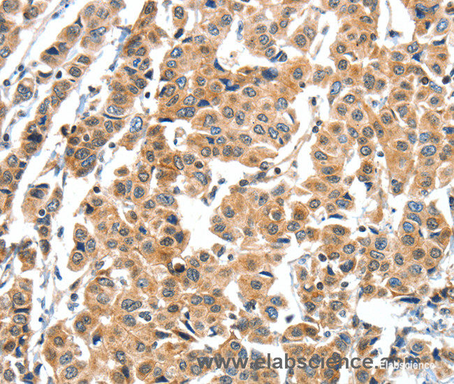 Immunohistochemistry of paraffin-embedded Human breast cancer tissue using XBP1 Polyclonal Antibody at dilution 1:60