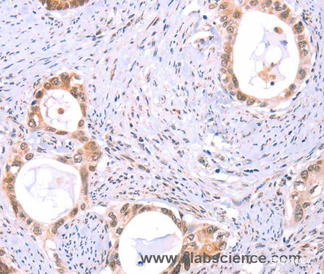 Immunohistochemistry of paraffin-embedded Human cervical cancer tissue using PROS1 Polyclonal Antibody at dilution 1:60