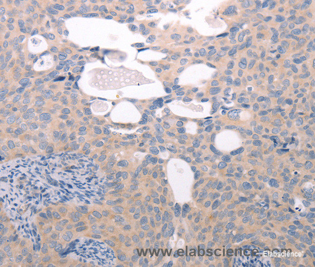 Immunohistochemistry of paraffin-embedded Human cervical cancer tissue using ABCF1 Polyclonal Antibody at dilution 1:40