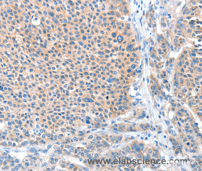 Immunohistochemistry of paraffin-embedded Human liver cancer tissue using ADAM20 Polyclonal Antibody at dilution 1:50