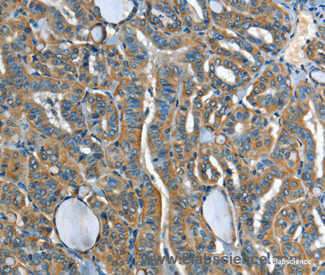 Immunohistochemistry of paraffin-embedded Human thyroid cancer tissue using ADCY4 Polyclonal Antibody at dilution 1:45
