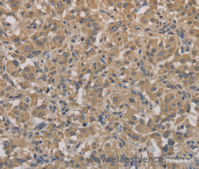 Immunohistochemistry of paraffin-embedded Human thyroid cancer tissue using AGTRAP Polyclonal Antibody at dilution 1:40