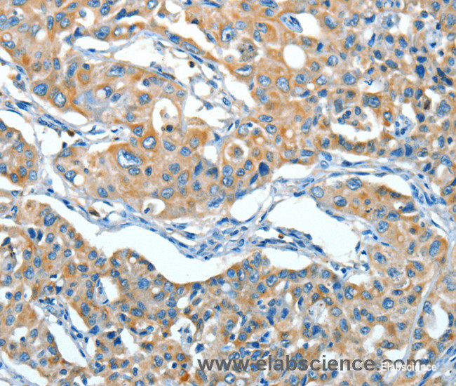 Immunohistochemistry of paraffin-embedded Human lung cancer tissue using SERPINA3 Polyclonal Antibody at dilution 1:55