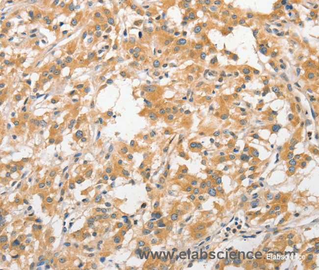 Immunohistochemistry of paraffin-embedded Human thyroid cancer tissue using APC5 Polyclonal Antibody at dilution 1:30