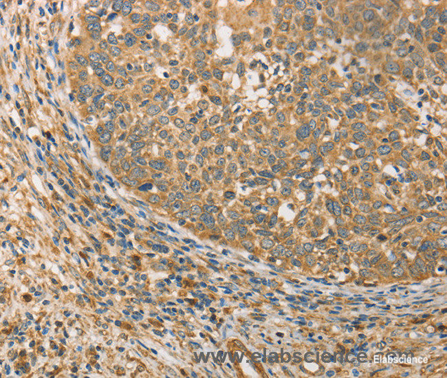 Immunohistochemistry of paraffin-embedded Human cervical cancer tissue using ATG3 Polyclonal Antibody at dilution 1:40