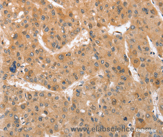 Immunohistochemistry of paraffin-embedded Human liver cancer tissue using ATG12 Polyclonal Antibody at dilution 1:70