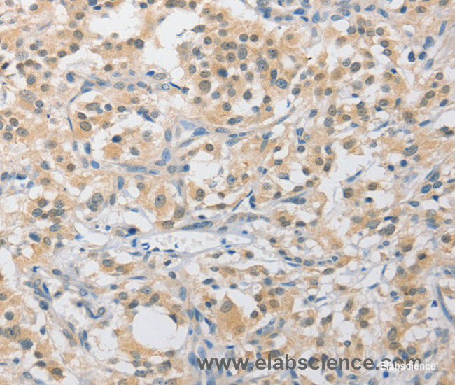 Immunohistochemistry of paraffin-embedded Human thyroid cancer tissue using APLF Polyclonal Antibody at dilution 1:40