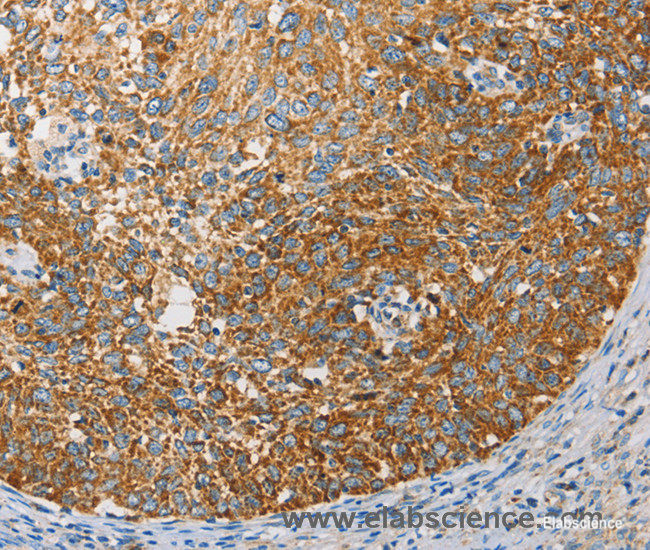 Immunohistochemistry of paraffin-embedded Human cervical cancer tissue using APOBEC3G Polyclonal Antibody at dilution 1:50