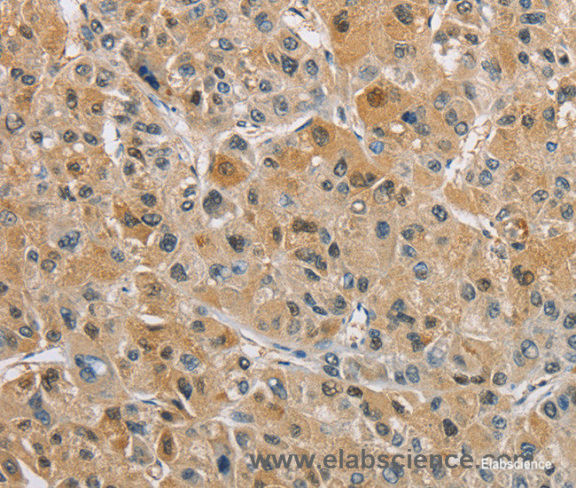 Immunohistochemistry of paraffin-embedded Human liver cancer tissue using NAPSA Polyclonal Antibody at dilution 1:40