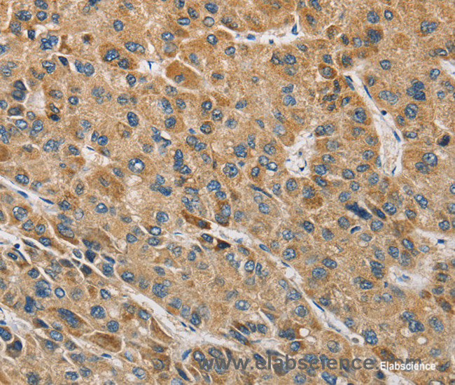 Immunohistochemistry of paraffin-embedded Human liver cancer tissue using MIP Polyclonal Antibody at dilution 1:60