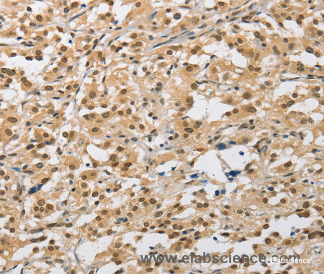 Immunohistochemistry of paraffin-embedded Human thyroid cancer tissue using AMZ2 Polyclonal Antibody at dilution 1:40