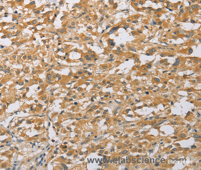 Immunohistochemistry of paraffin-embedded Human thyroid cancer tissue using ARHGEF1 Polyclonal Antibody at dilution 1:50