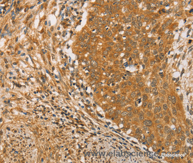 Immunohistochemistry of paraffin-embedded Human cervical cancer tissue using ARMCX3 Polyclonal Antibody at dilution 1:40