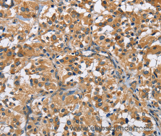 Immunohistochemistry of paraffin-embedded Human thyroid cancer tissue using FLT3 Polyclonal Antibody at dilution 1:50