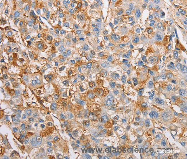 Immunohistochemistry of paraffin-embedded Human liver cancer tissue using IKK gamma Polyclonal Antibody at dilution 1:60