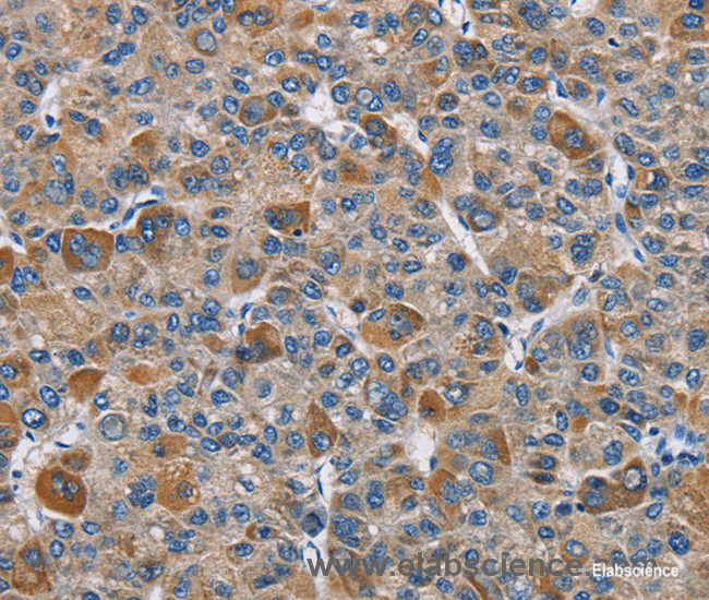 Immunohistochemistry of paraffin-embedded Human liver cancer tissue using DNMT3A Polyclonal Antibody at dilution 1:50