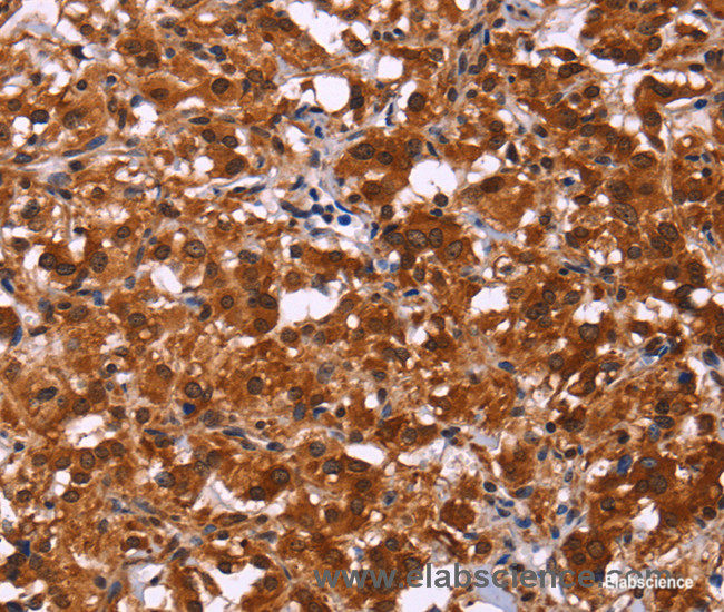 Immunohistochemistry of paraffin-embedded Human thyroid cancer tissue using ART5 Polyclonal Antibody at dilution 1:50