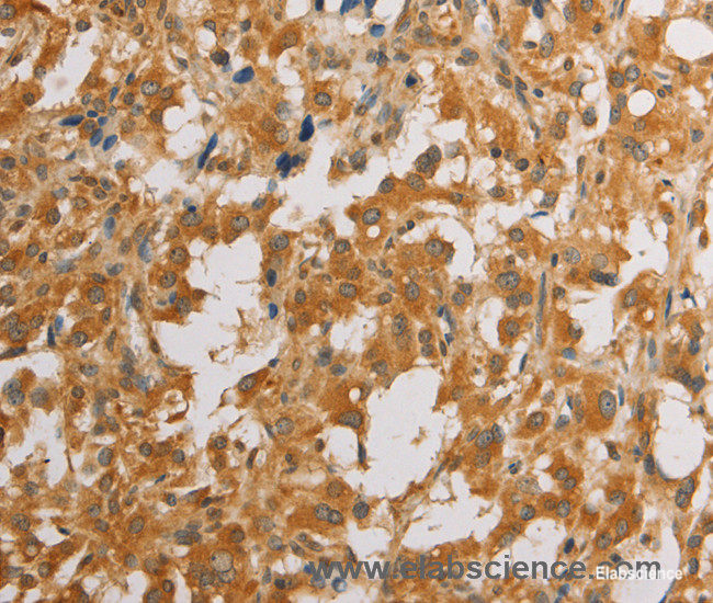 Immunohistochemistry of paraffin-embedded Human thyroid cancer tissue using ATG4D Polyclonal Antibody at dilution 1:40