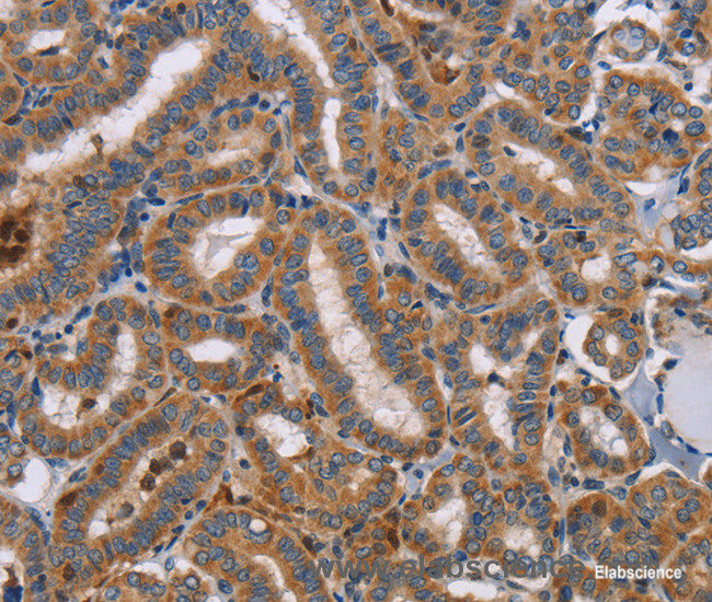 Immunohistochemistry of paraffin-embedded Human thyroid cancer tissue using TLR8 Polyclonal Antibody at dilution 1:40