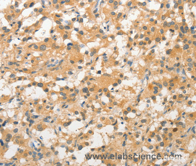 Immunohistochemistry of paraffin-embedded Human thyroid cancer tissue using STAM Polyclonal Antibody at dilution 1:40