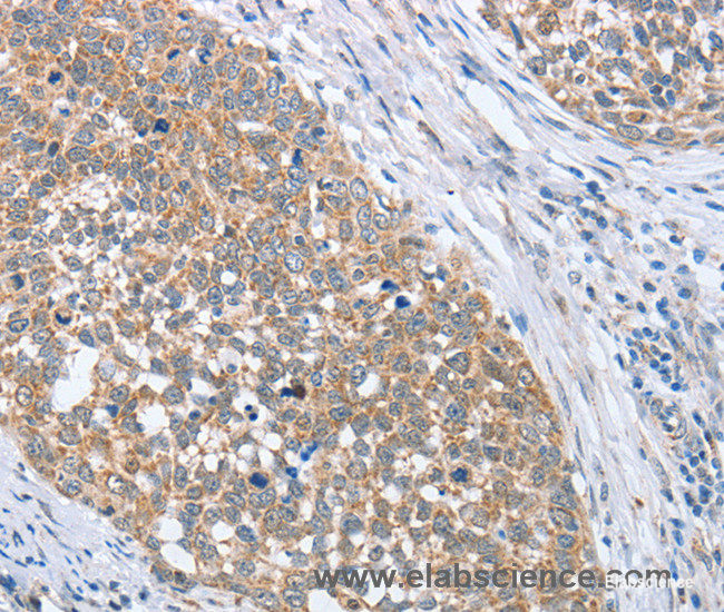Immunohistochemistry of paraffin-embedded Human cervical cancer tissue using PAPSS1 Polyclonal Antibody at dilution 1:40