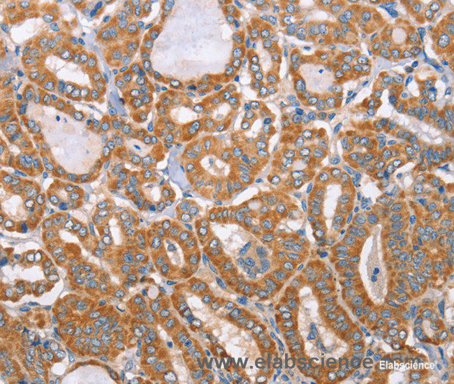 Immunohistochemistry of paraffin-embedded Human thyroid cancer tissue using MTMR7 Polyclonal Antibody at dilution 1:40