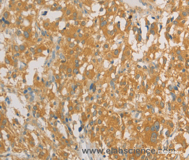 Immunohistochemistry of paraffin-embedded Human thyroid cancer tissue using PRPSAP1 Polyclonal Antibody at dilution 1:80