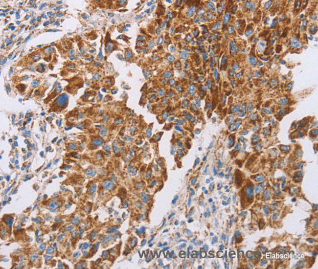 Immunohistochemistry of paraffin-embedded Human lung cancer tissue using GUCY1A3 Polyclonal Antibody at dilution 1:40