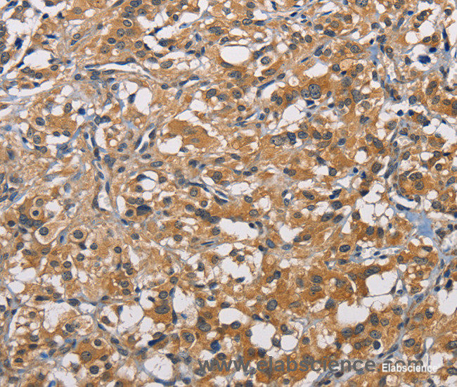 Immunohistochemistry of paraffin-embedded Human thyroid cancer tissue using PIKFYVE Polyclonal Antibody at dilution 1:50