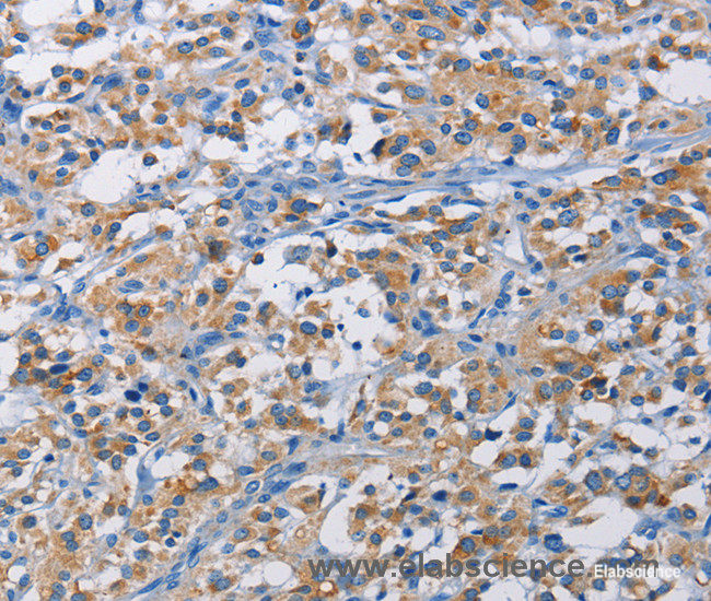 Immunohistochemistry of paraffin-embedded Human thyroid cancer tissue using RICTOR Polyclonal Antibody at dilution 1:50