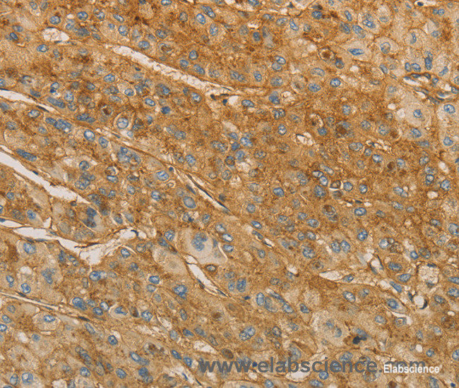Immunohistochemistry of paraffin-embedded Human liver cancer tissue using VTN Polyclonal Antibody at dilution 1:40