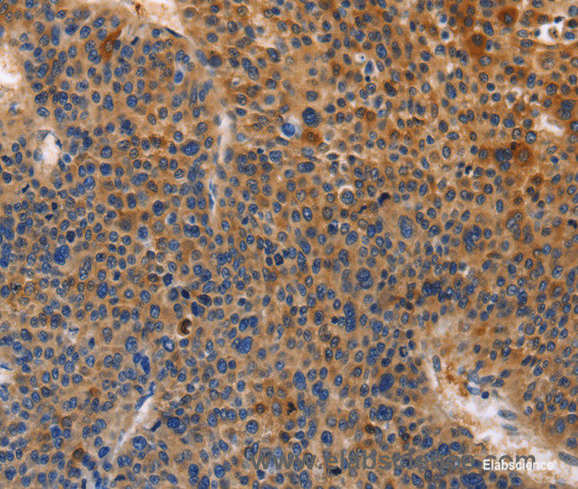 Immunohistochemistry of paraffin-embedded Human liver cancer tissue using MUSK Polyclonal Antibody at dilution of 1:30