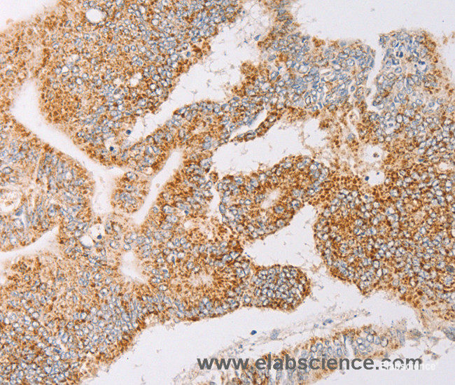 Immunohistochemistry of paraffin-embedded Human colon cancer tissue using YARS2 Polyclonal Antibody at dilution 1:30