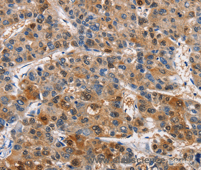 Immunohistochemistry of paraffin-embedded Human liver cancer tissue using PIM1 Polyclonal Antibody at dilution 1:40