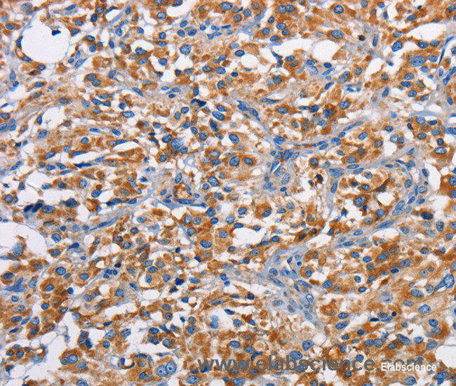 Immunohistochemistry of paraffin-embedded Human thyroid cancer tissue using PIM2 Polyclonal Antibody at dilution 1:40