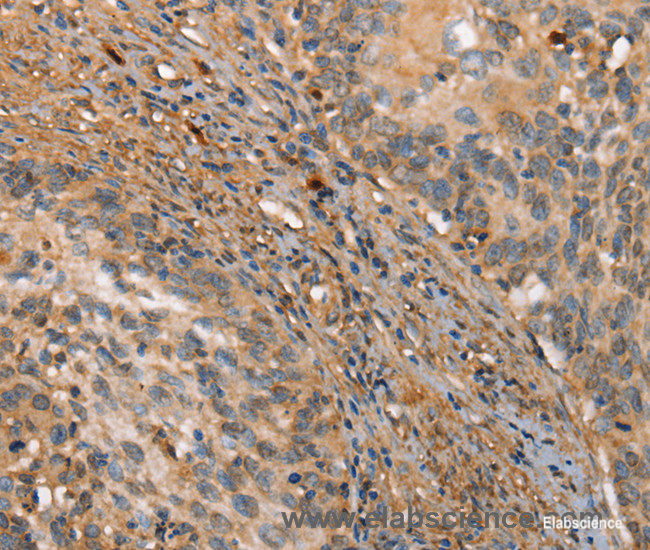 Immunohistochemistry of paraffin-embedded Human cervical cancer tissue using HK3 Polyclonal Antibody at dilution 1:40