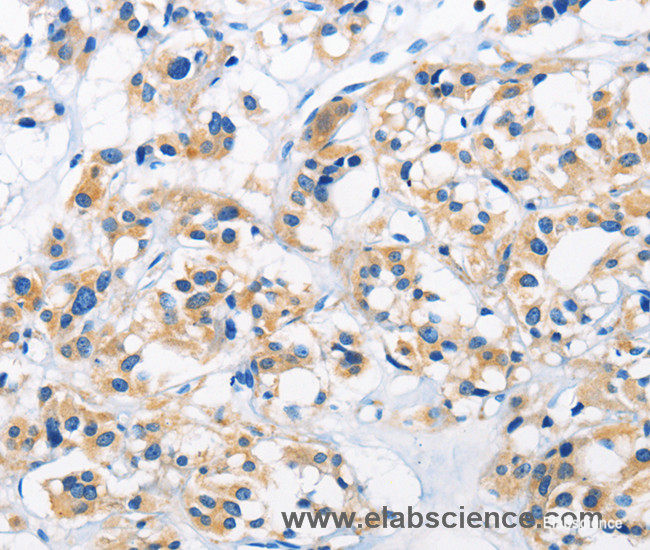 Immunohistochemistry of paraffin-embedded Human thyroid cancer tissue using HK1 Polyclonal Antibody at dilution 1:50
