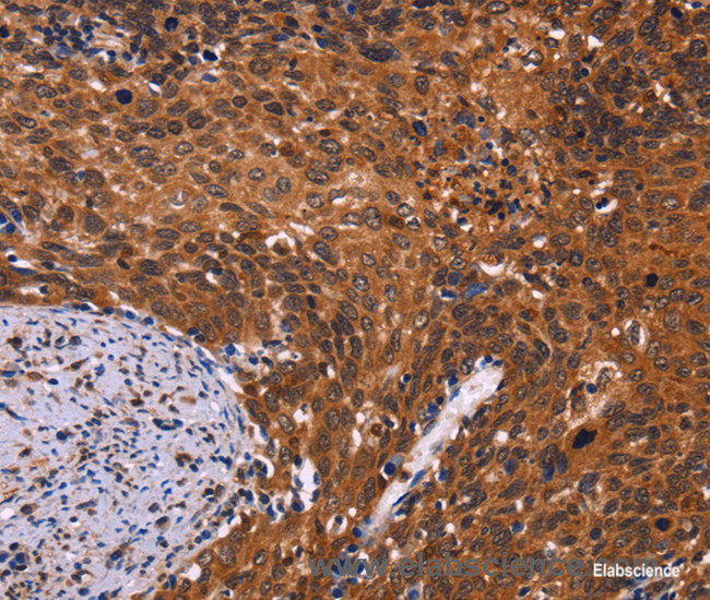 Immunohistochemistry of paraffin-embedded Human cervical cancer tissue using CDC5L Polyclonal Antibody at dilution 1:40