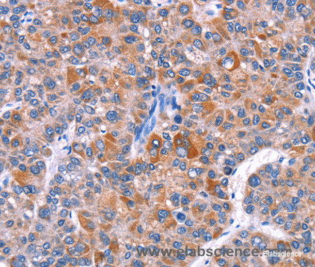 Immunohistochemistry of paraffin-embedded Human liver cancer tissue using ELP2 Polyclonal Antibody at dilution 1:40