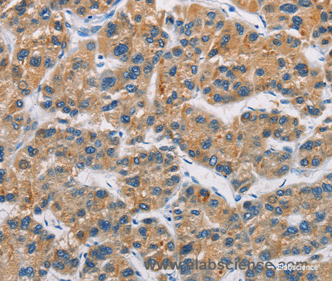 Immunohistochemistry of paraffin-embedded Human liver cancer tissue using CERK Polyclonal Antibody at dilution 1:30