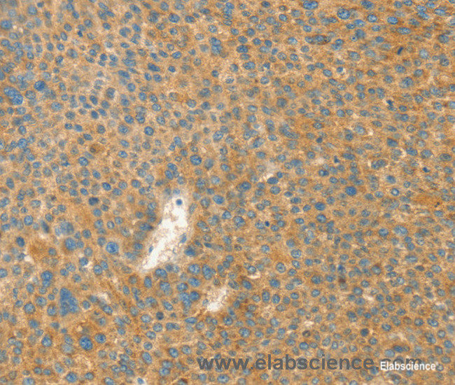 Immunohistochemistry of paraffin-embedded Human liver cancer tissue using AANAT Polyclonal Antibody at dilution 1:40