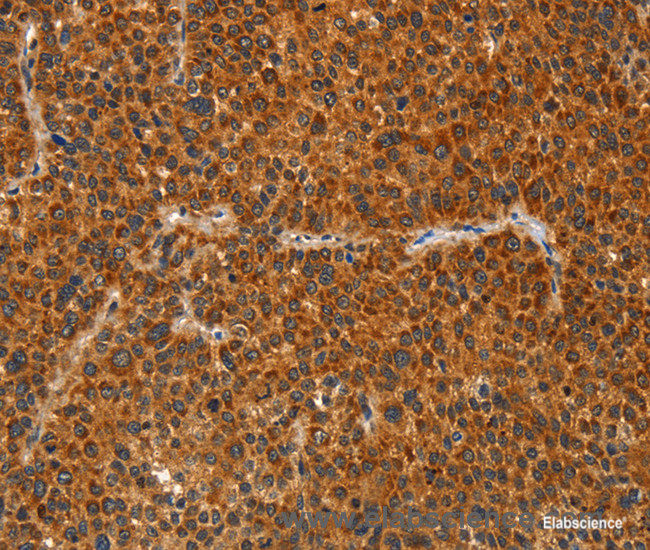 Immunohistochemistry of paraffin-embedded Human liver cancer tissue using IKZF3 Polyclonal Antibody at dilution 1:60