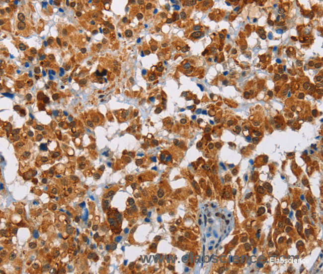 Immunohistochemistry of paraffin-embedded Human thyroid cancer tissue using ATXN1 Polyclonal Antibody at dilution 1:40