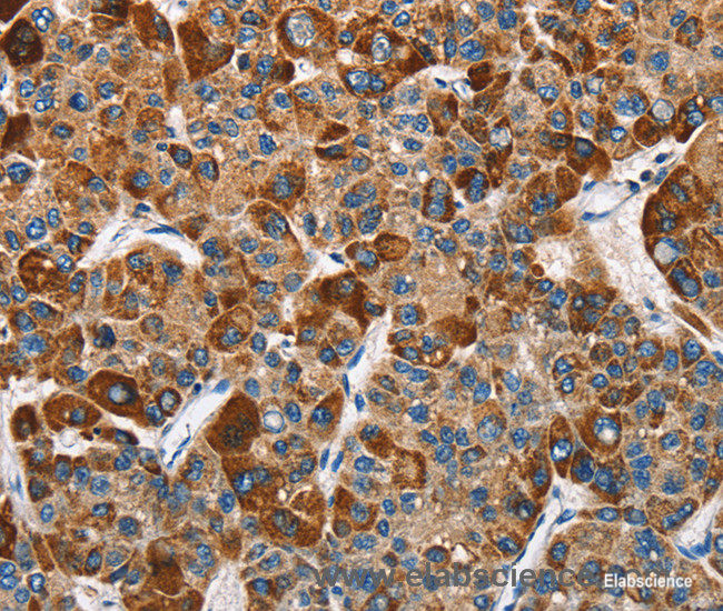 Immunohistochemistry of paraffin-embedded Human liver cancer tissue using SLAMF8 Polyclonal Antibody at dilution 1:40
